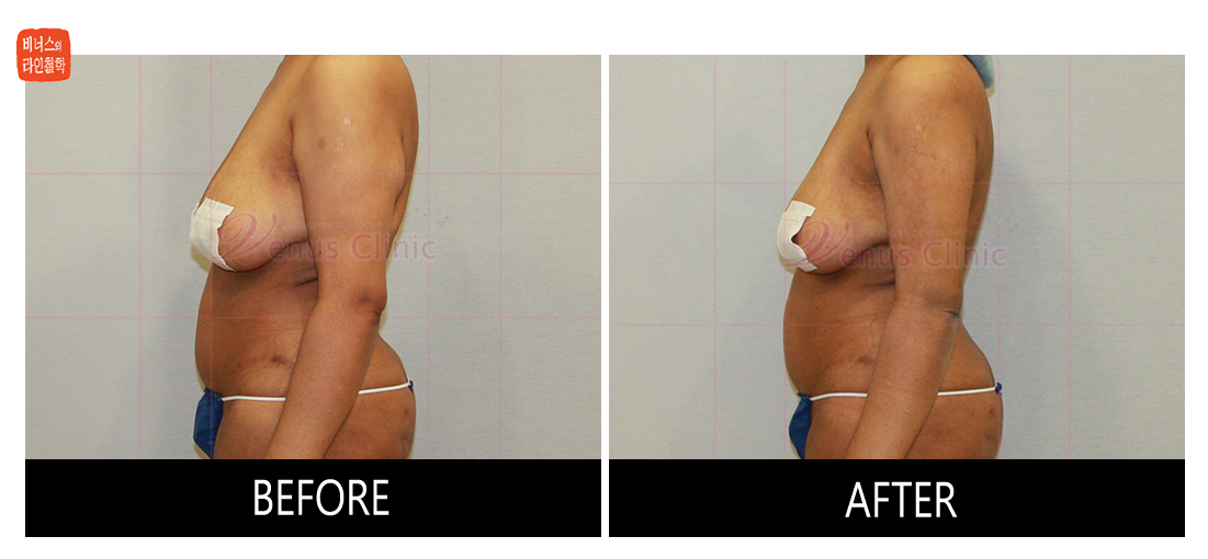 reoperation liposuction of arms2.jpg
