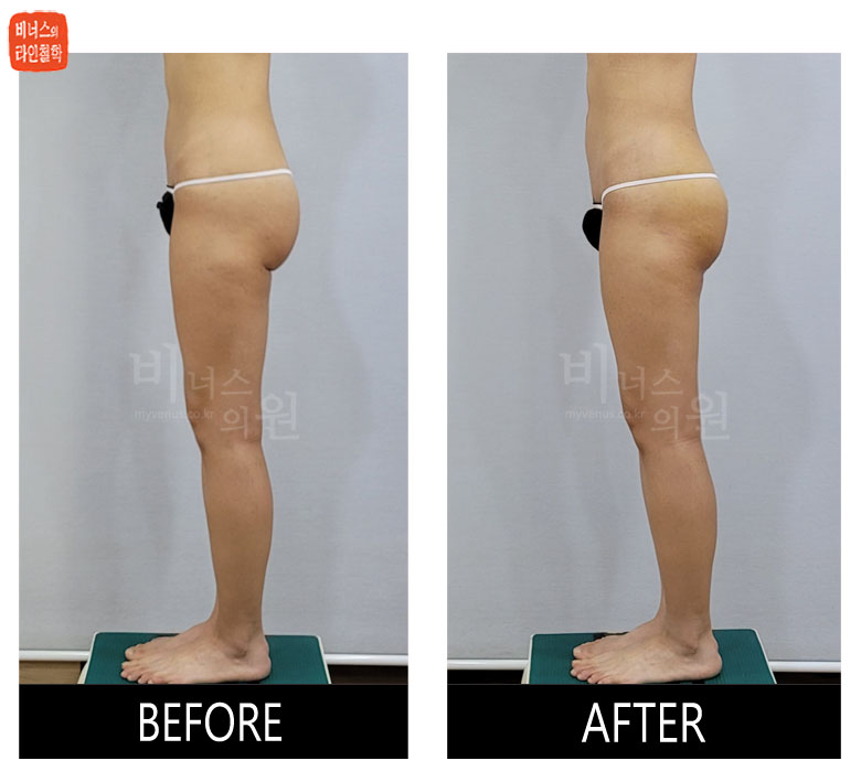 Buttock volume-up revision liposuction before and after, side view