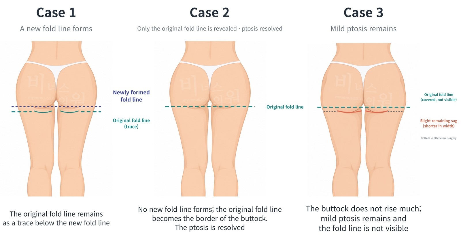 Three appearances of the crease after buttock volume-up liposuction — Case 1 a new crease forms, Case 2 only the original crease is revealed, Case 3 some ptosis remains