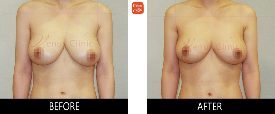 liposuction for breast reduction4