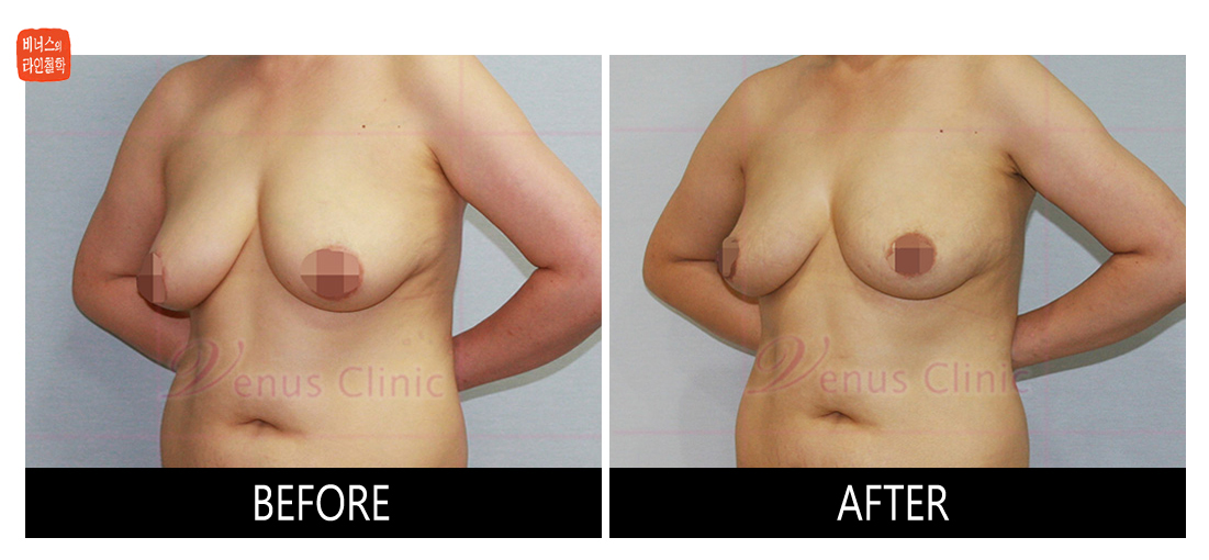 liposuction for breast reduction2