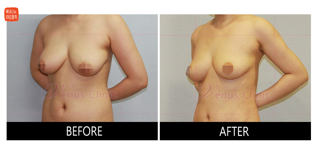 liposuction for breast reduction1