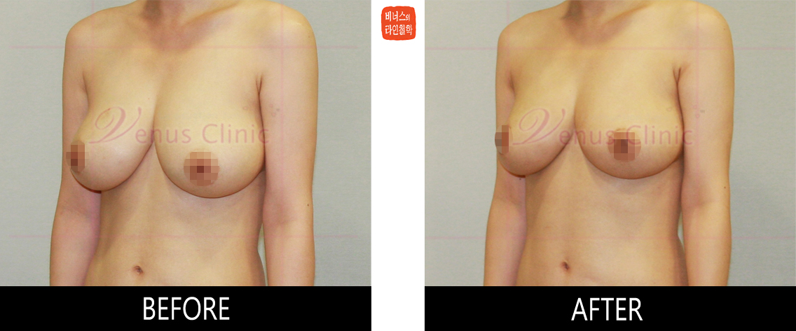 liposuction for breast reduction4