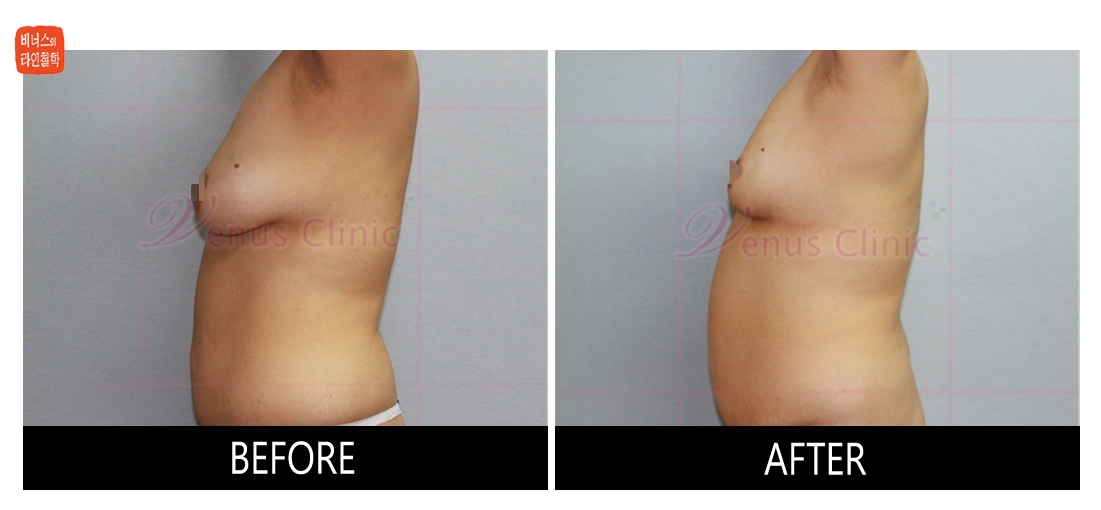 liposuction for breast reduction5