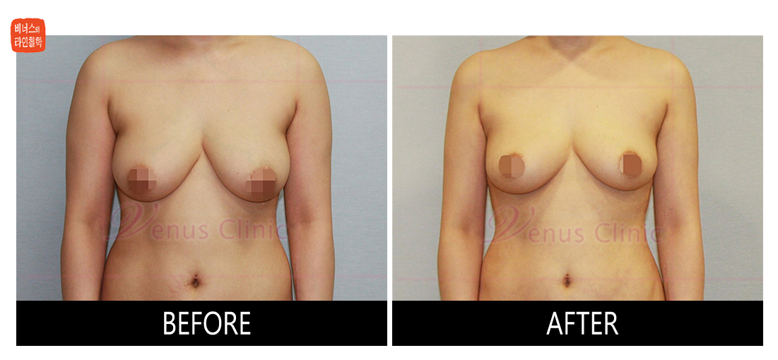 liposuction for breast reduction
