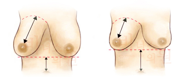 liposuction for breast reduction-5.jpg