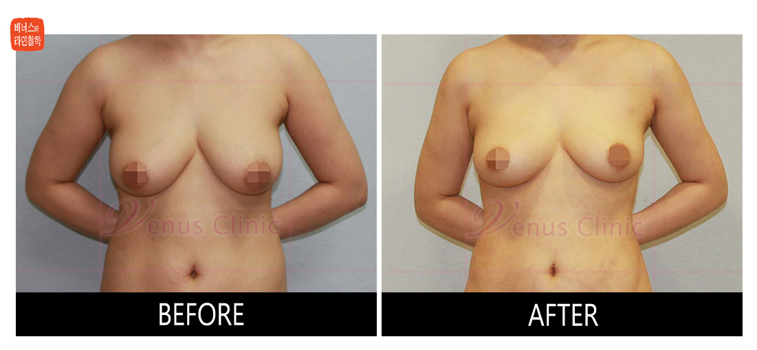 liposuction for breast reduction1