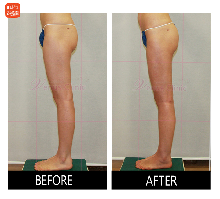 buttocks liposuction5.jpg