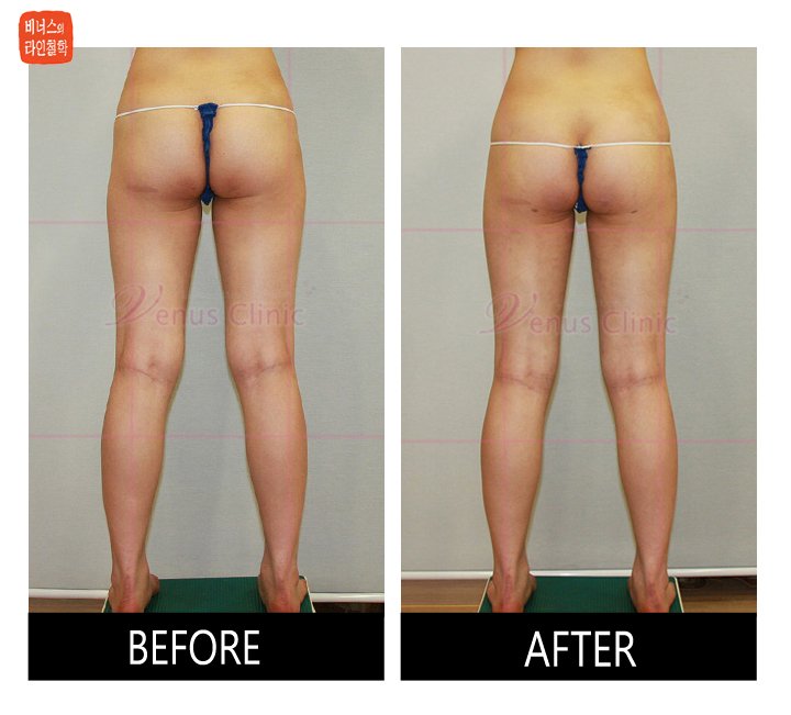 buttocks liposuction4.jpg