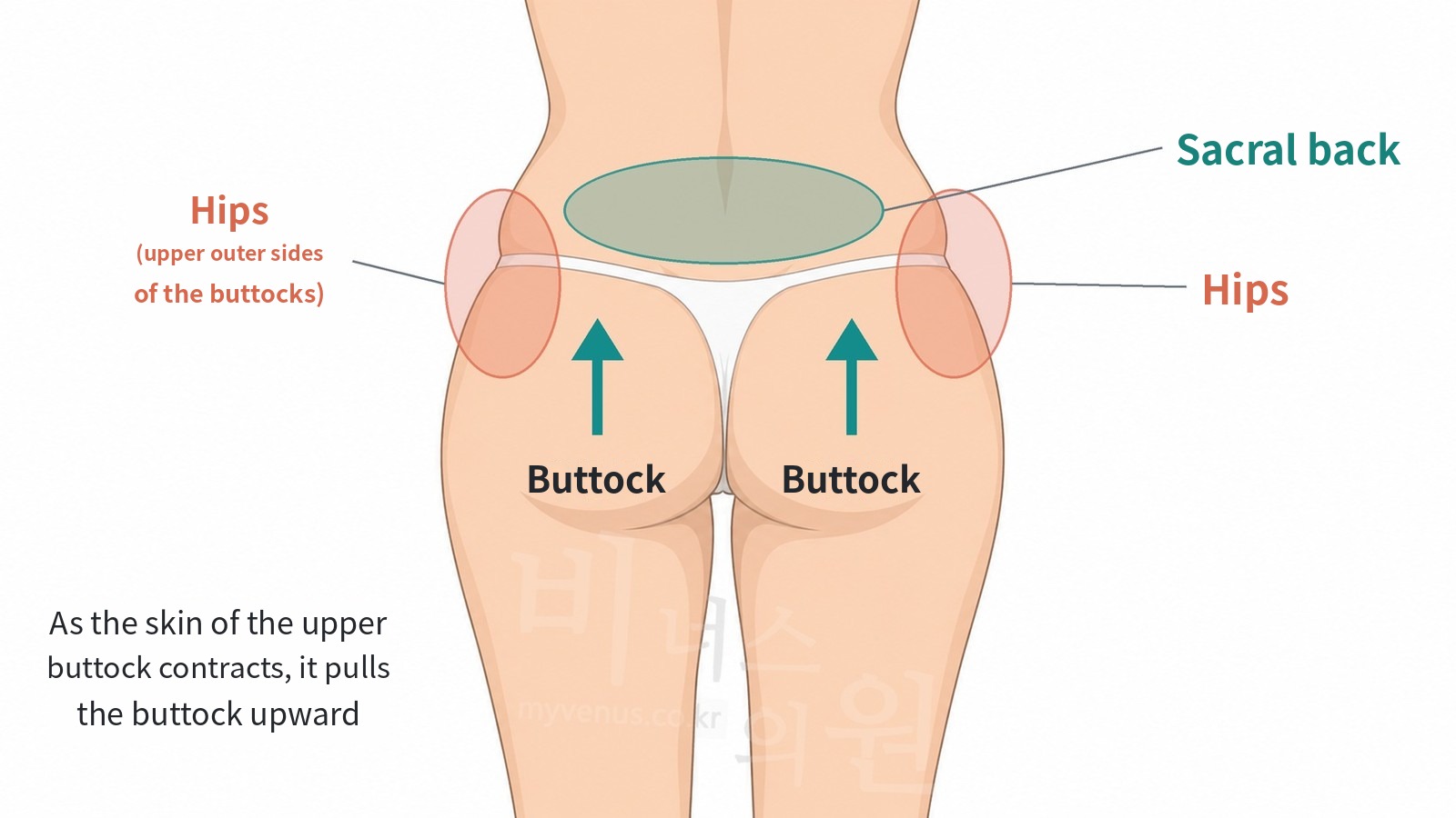 Rear view showing the hips, sacral back and buttocks, and the direction in which the skin contracts after liposuction to pull the buttocks upward