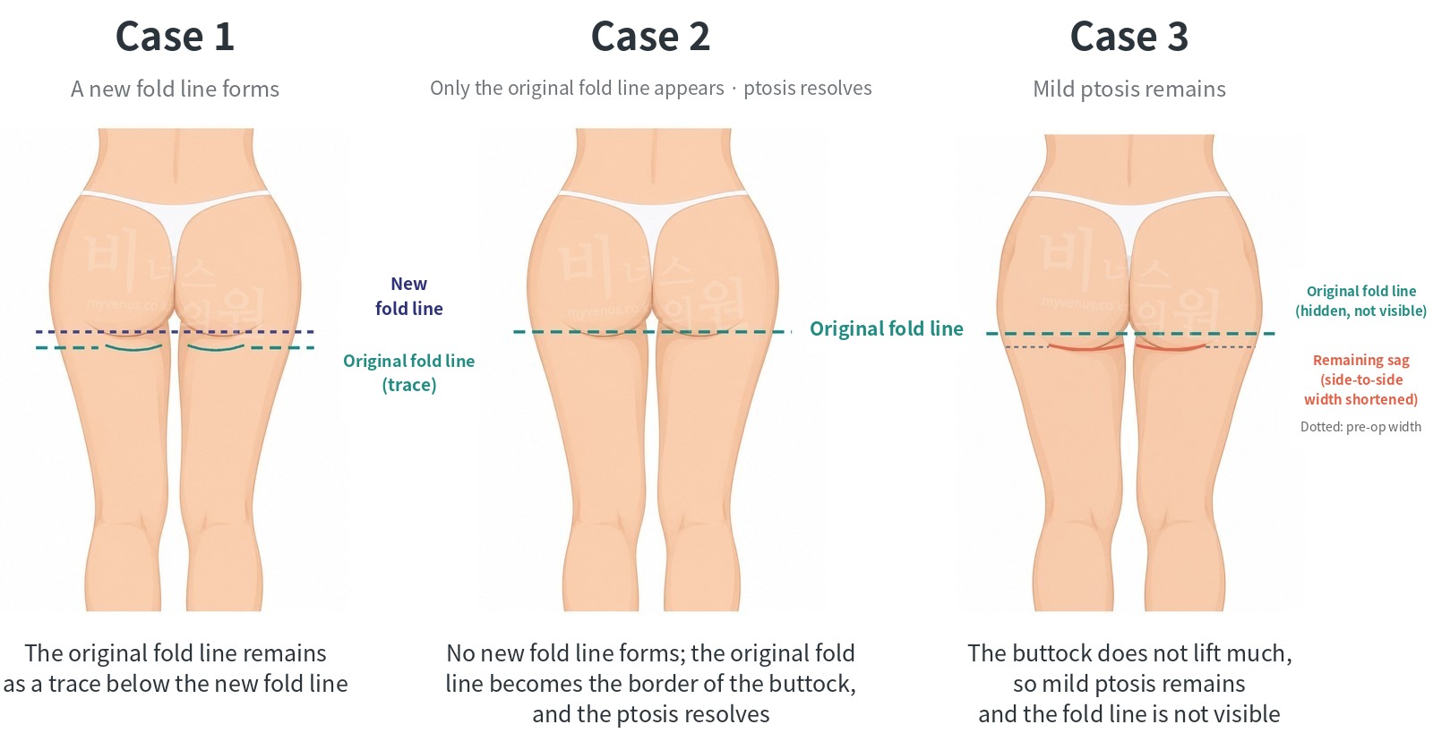 Three appearances of the fold line after buttock volume-up liposuction: Case 1 a new fold line forms, Case 2 only the original fold line appears, Case 3 mild ptosis remains