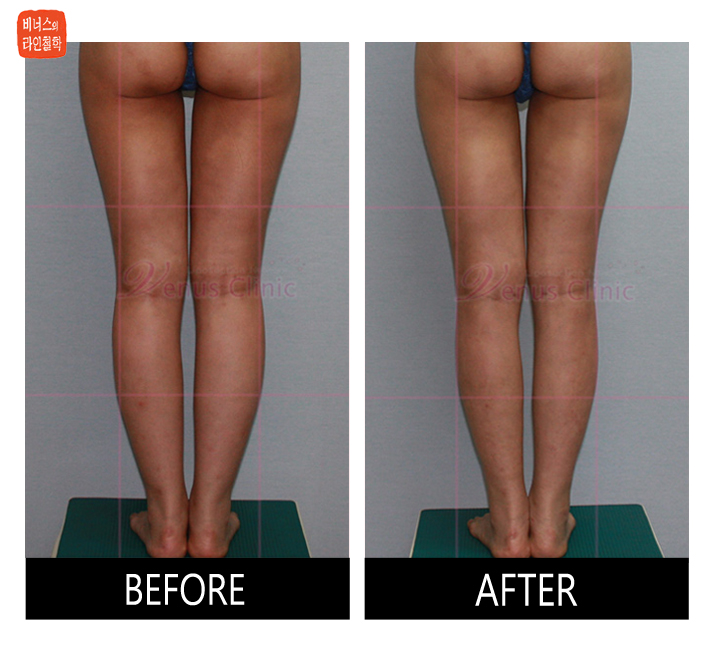 Calf and Ankle Liposuction