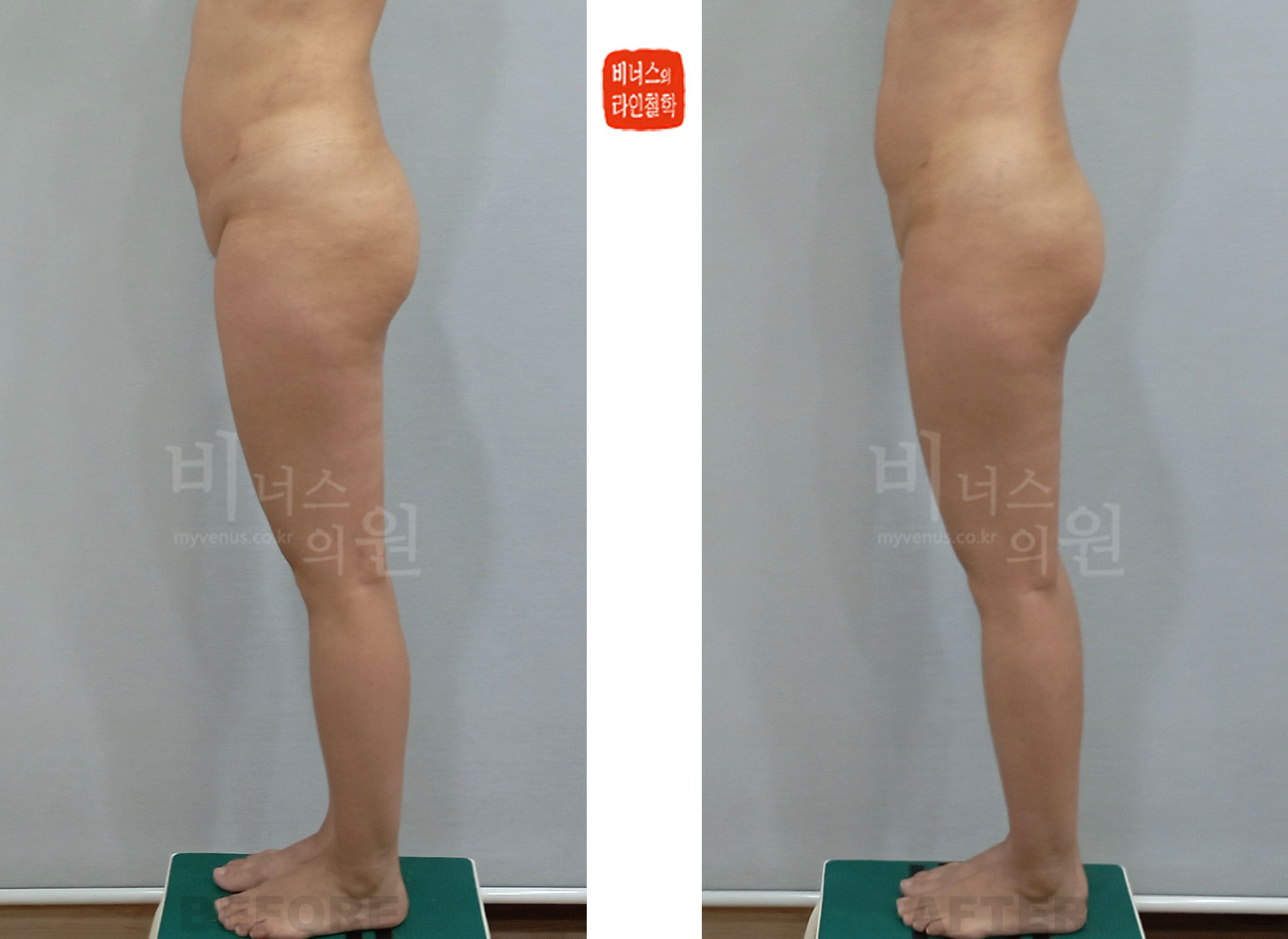 2024 side-view before-and-after photos of mons pubis, anterior pelvis, and upper-thigh liposuction, Case 1