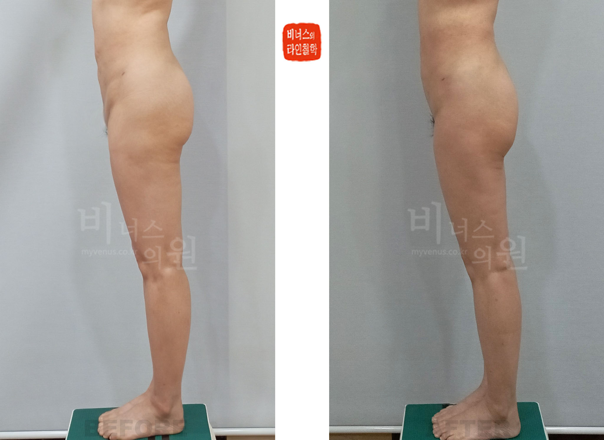 2024 side-view before-and-after photos of mons pubis, anterior pelvis, and upper-thigh liposuction, Case 2