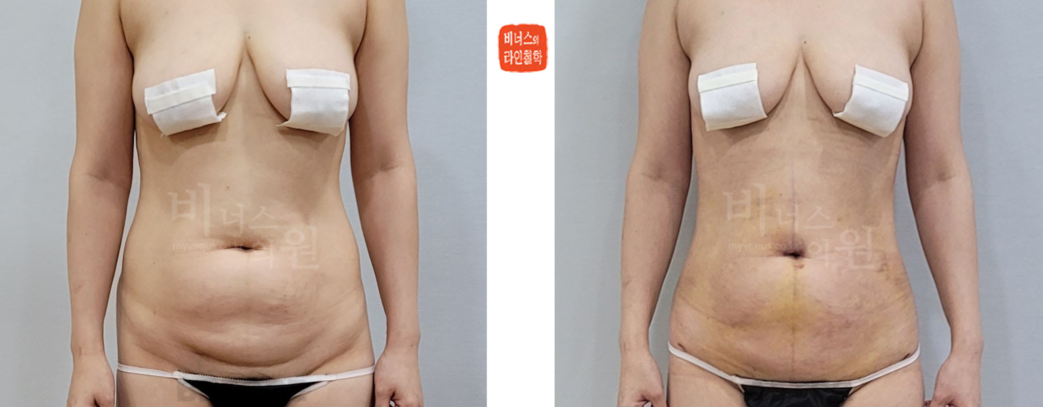 2026 front-view before-and-after photos of upper abdomen, lower abdomen, flank, and pubic-area liposuction