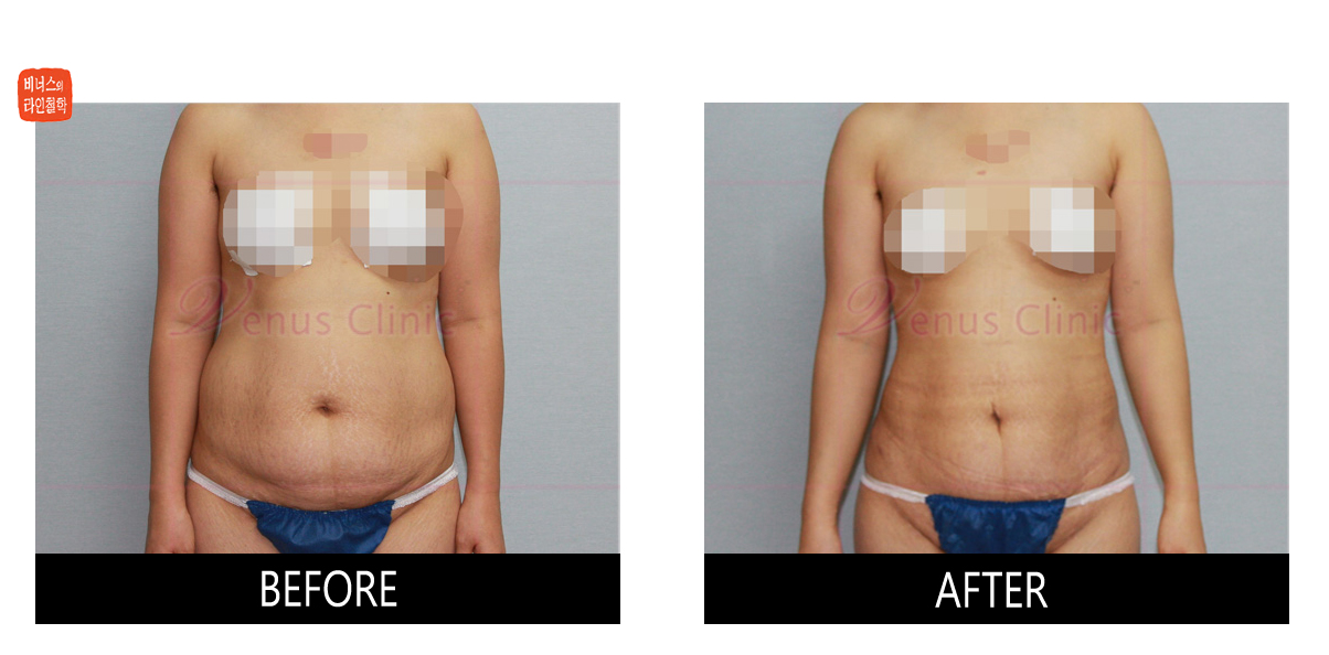 skin irregualarity after liposuction