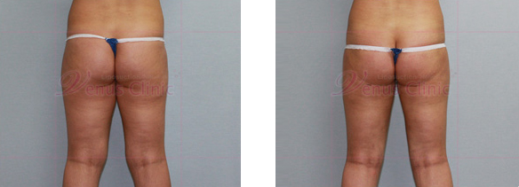 뒤쪽 허벅지의 위쪽부위(Upper posterior thigh) 지방흡입1