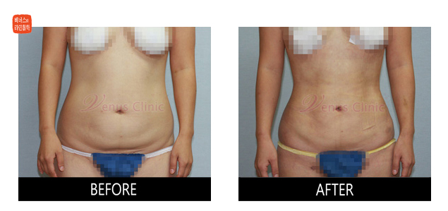 before and after abdominal liposuction2