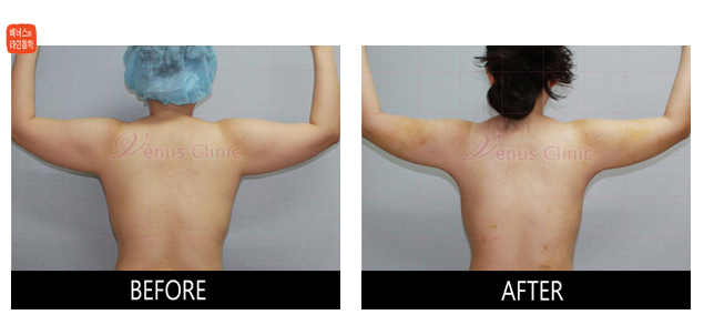 before and after liposuction of upper back
