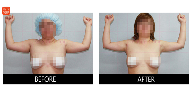 before and after liposuction of arms