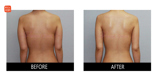before and after liposuction of lateral arms