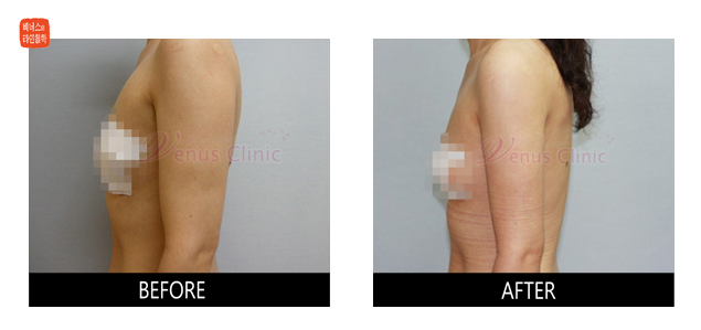 before and after liposuction of posterior arms