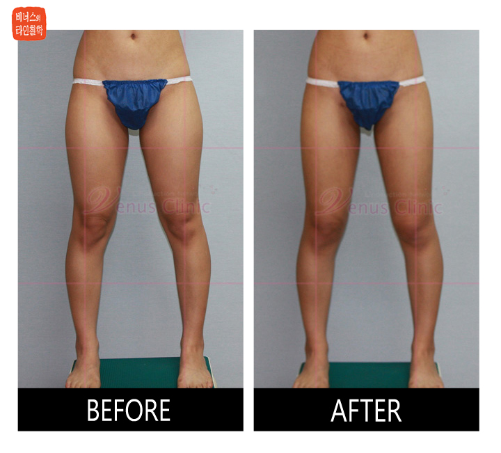liposuction of circumferential thighs3
