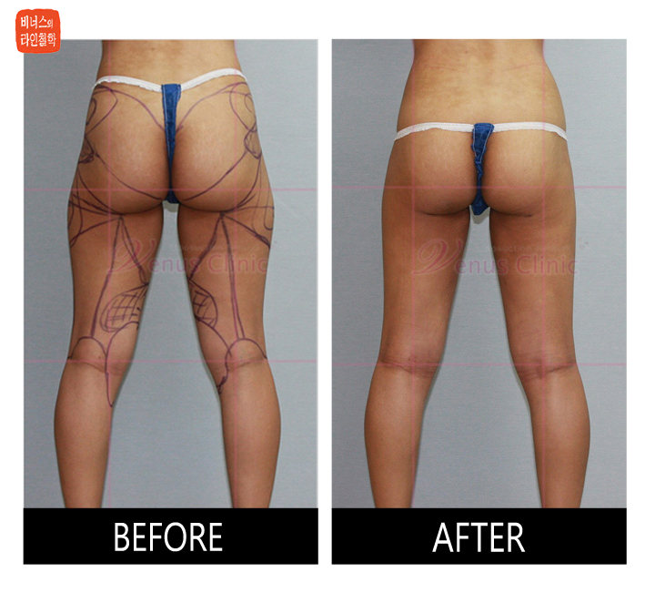 rear view of thighs before and after liposuction
