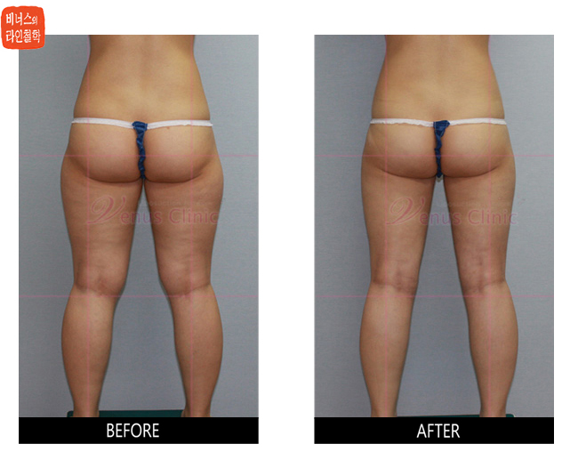 lateral thighs liposuction