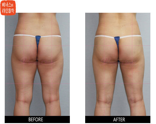 liposuction of knees