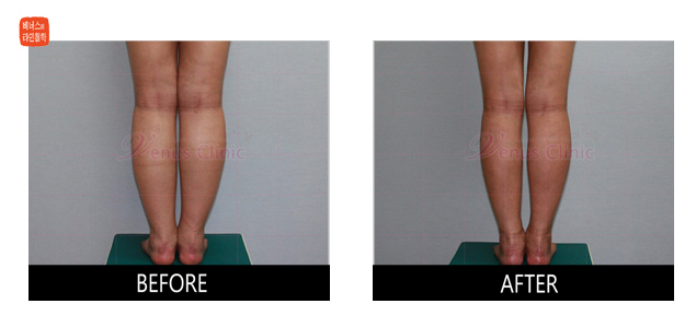 liposuction of calves after thighs