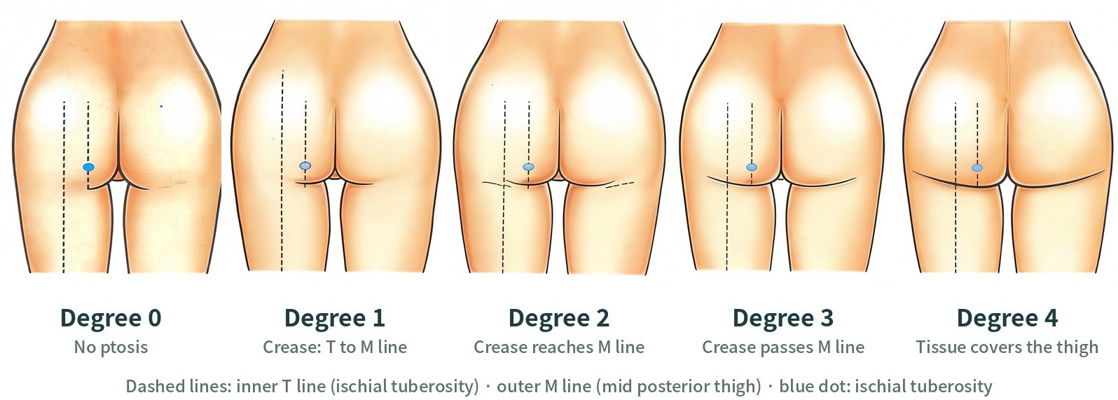 Rear views of buttock ptosis Degree 0–4
