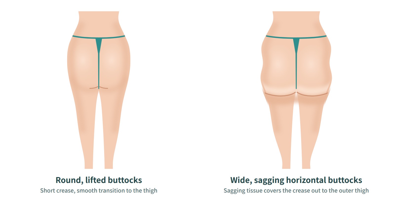 Rear view comparing firm, lifted buttocks with buttocks that spread to the sides and sag