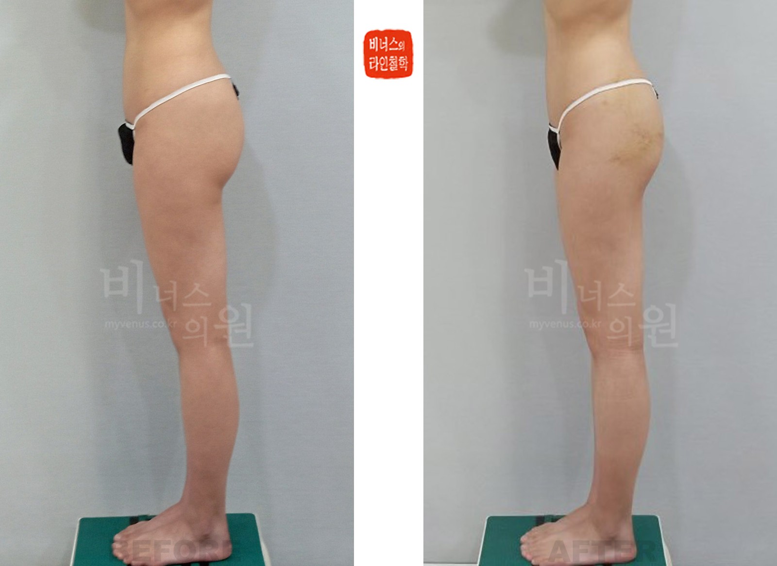 Before-and-after photo of liposuction for horizontally sagging buttocks, side view (one week after surgery)