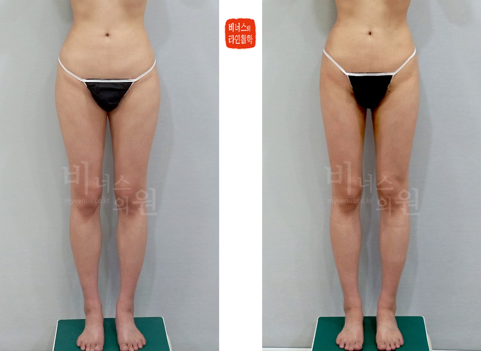 Before-and-after photo of liposuction for horizontally sagging buttocks, front view (one week after surgery)