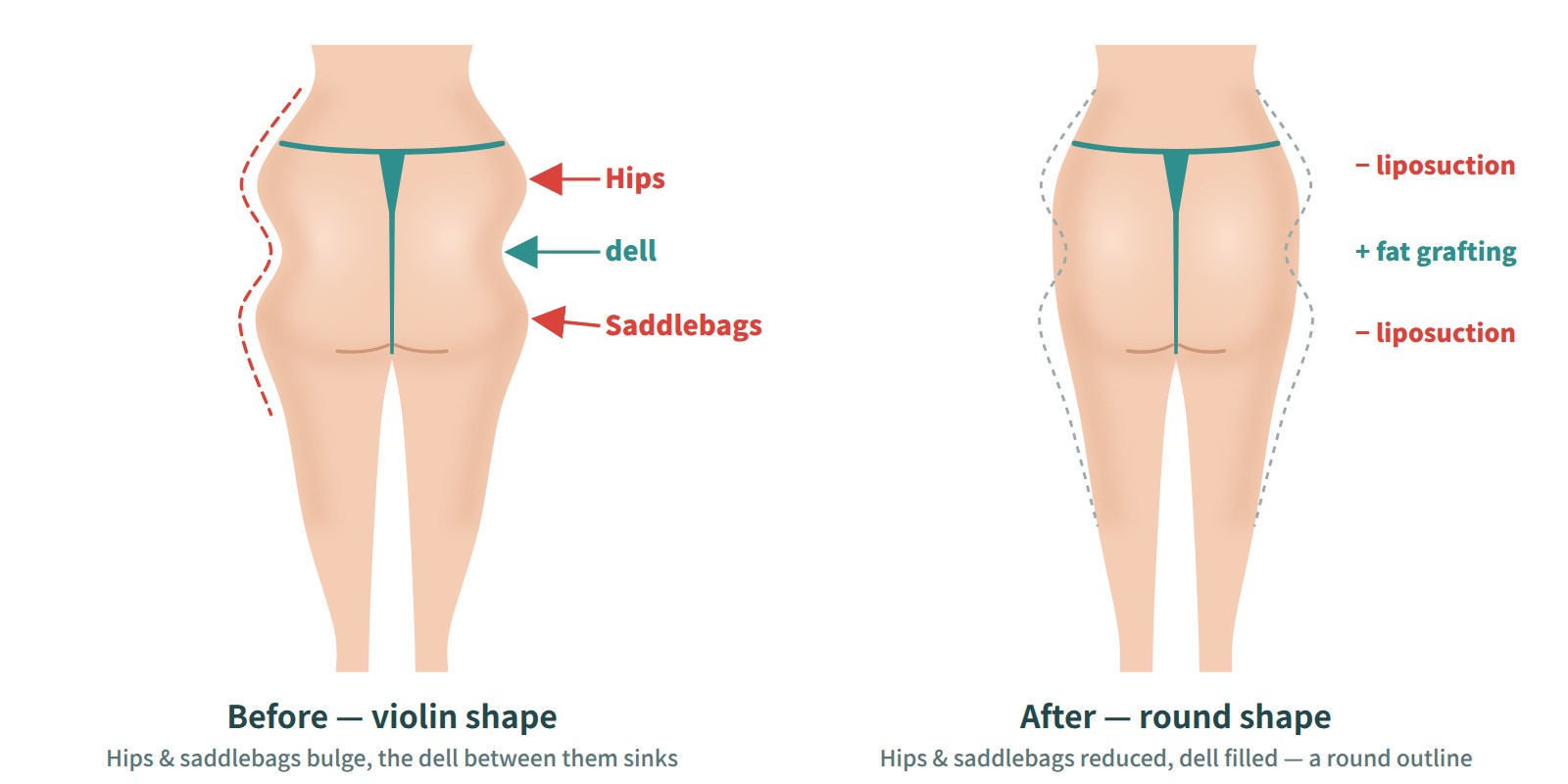 Virtual before-and-after rear view of combined hip, buttock, and saddlebag surgery