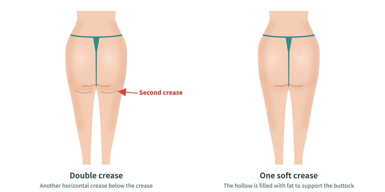 Virtual before-and-after rear view of banana fold and double crease fat grafting