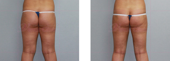 Buttock liposuction photo 3