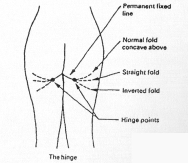 Various shapes of the buttock crease
