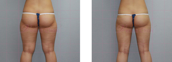 Buttock liposuction photo 2