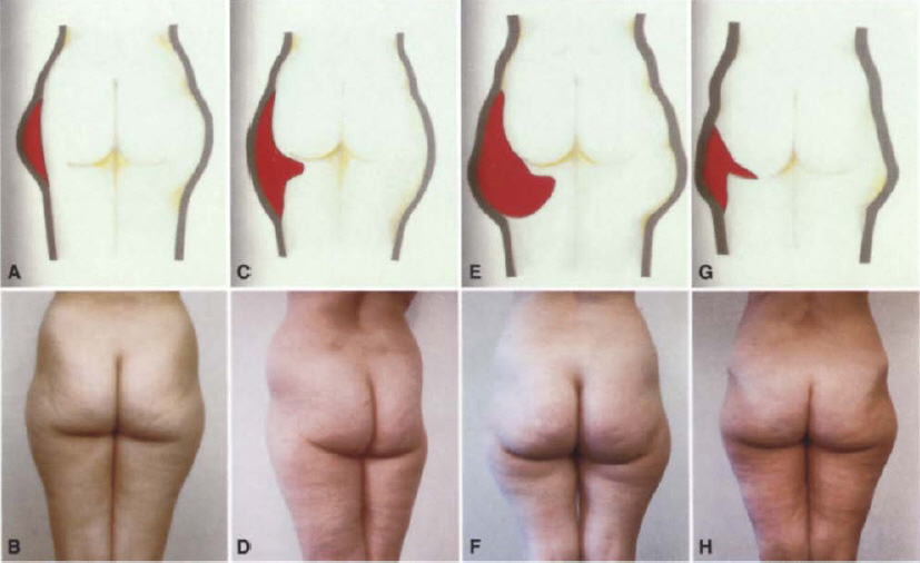 Gasparotti's saddlebag classification