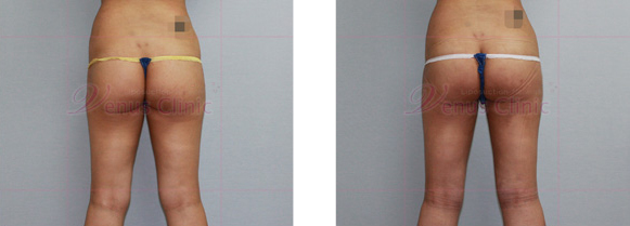 Buttock liposuction photo