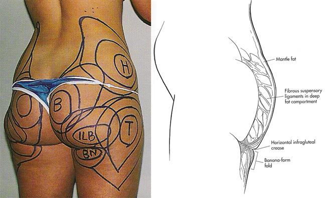 Names and anatomy of the buttock and thigh regions