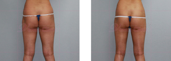 Buttock liposuction photo 4