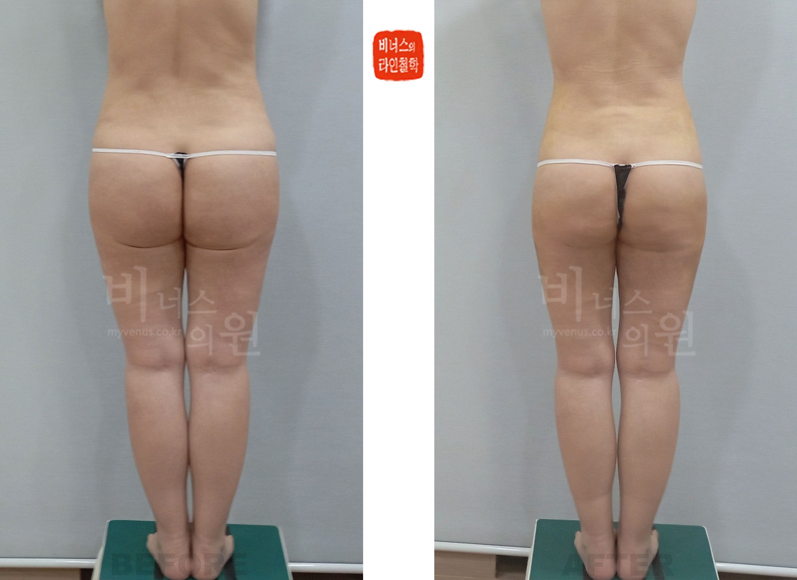 Buttock and thigh liposuction revision before-and-after, case 2, back view