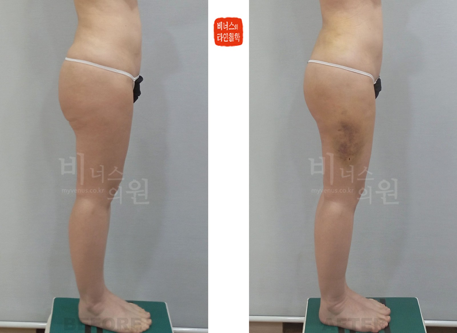 Buttock and thigh liposuction revision before-and-after, case 2, side view