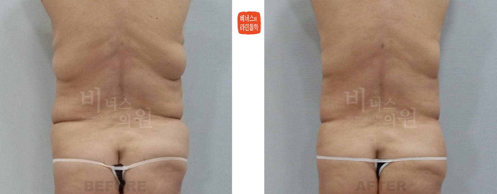 Abdominal liposuction revision before-and-after, case 1, back view