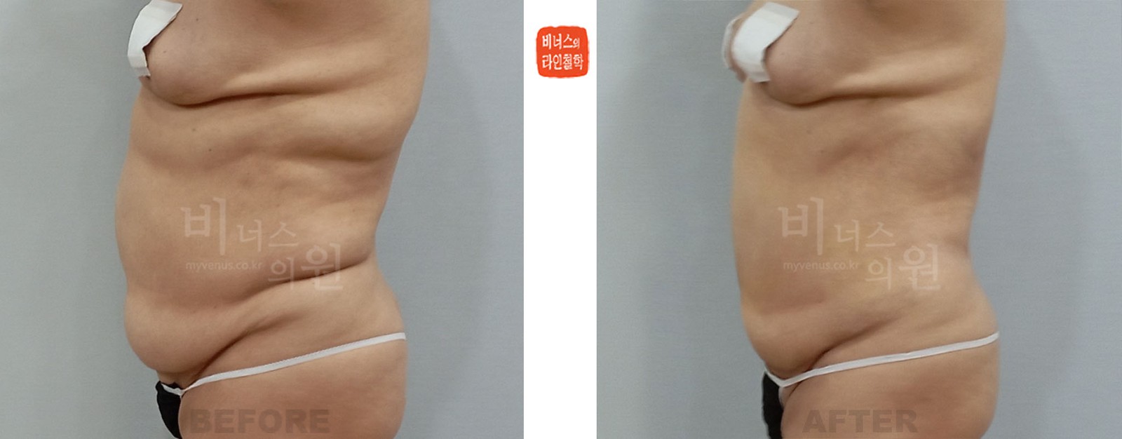 Abdominal liposuction revision before-and-after, case 1, side view