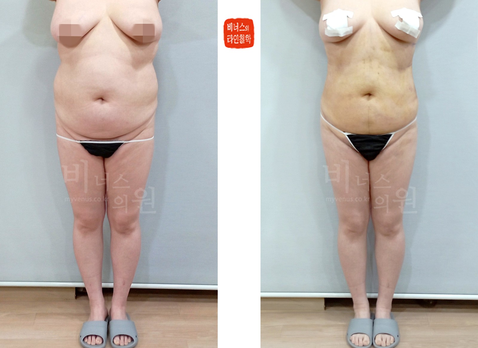 Abdominal liposuction before-and-after photo, front view (1 week after surgery)