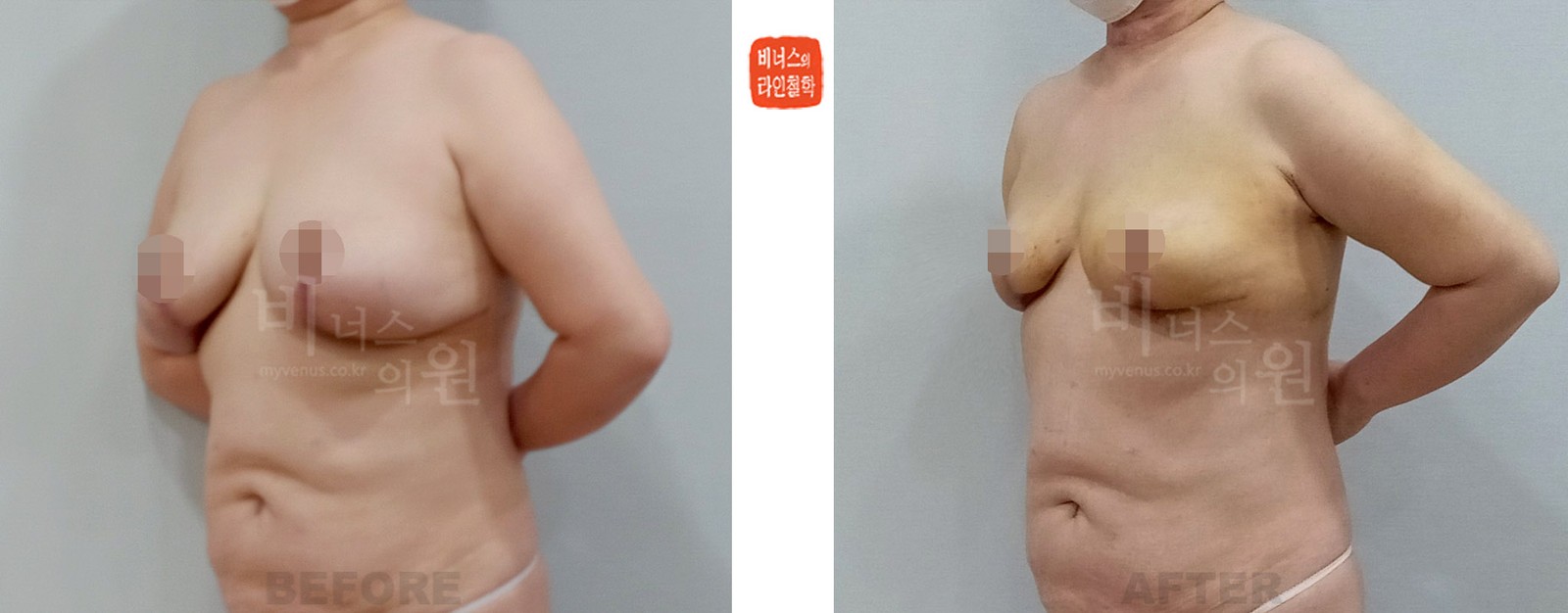 Before-and-after photos of breast reduction liposuction after excisional breast reduction, left oblique (1 week after surgery)